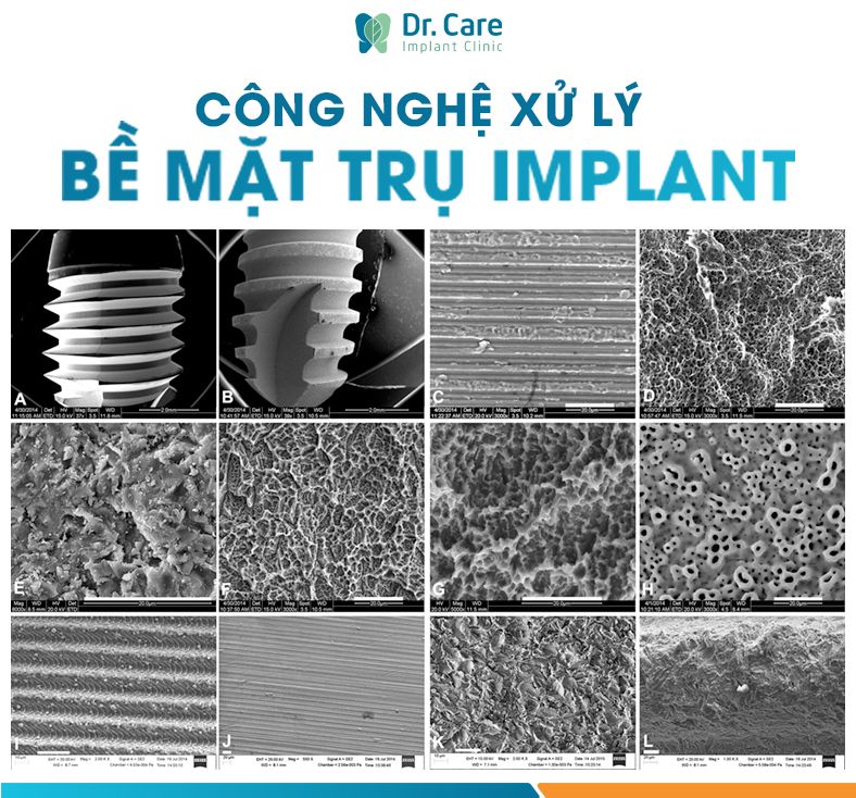 Công nghệ xử lý bề mặt trụ Implant khác nhau