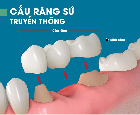 Cầu răng sứ truyền thống