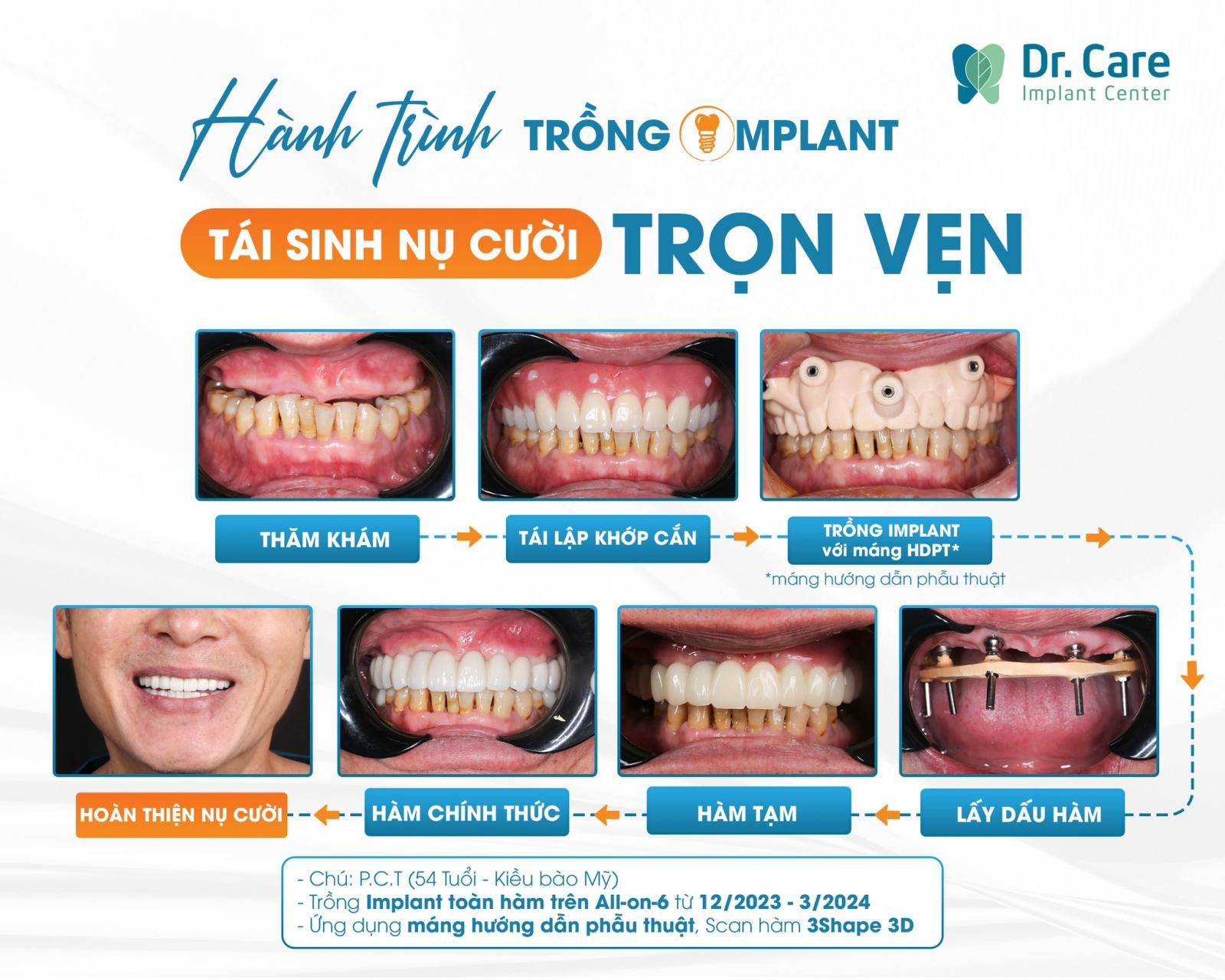 Tham khảo bảng giá dịch vụ nha khoa trồng răng trả góp tại Dr. Care