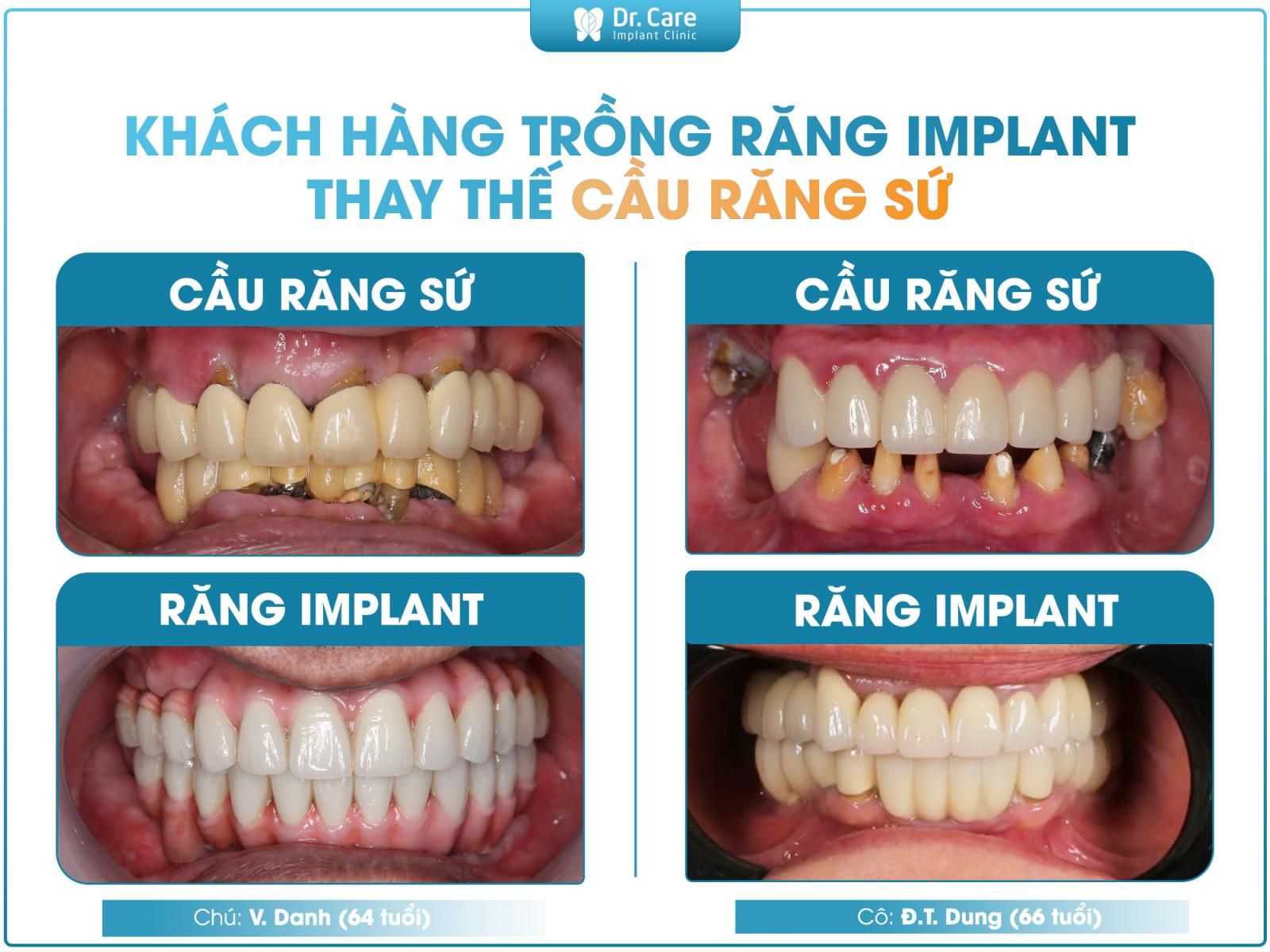 Cấy ghép Implant chỉ tác động tại vùng mất răng và không phải mài 2 răng thật kế cận để làm trụ, gây ảnh hưởng đến răng kế cận. 