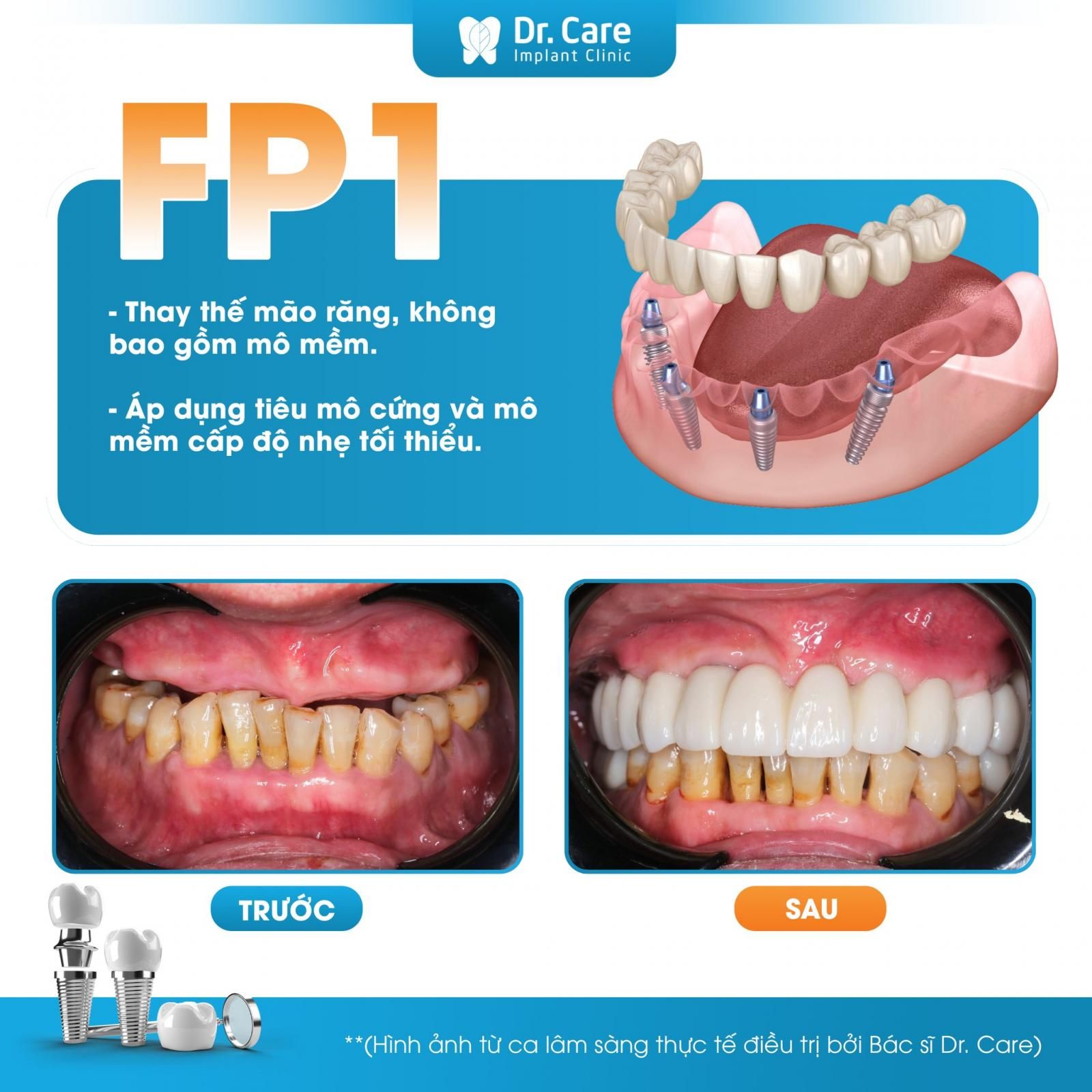 Phục hình FP1