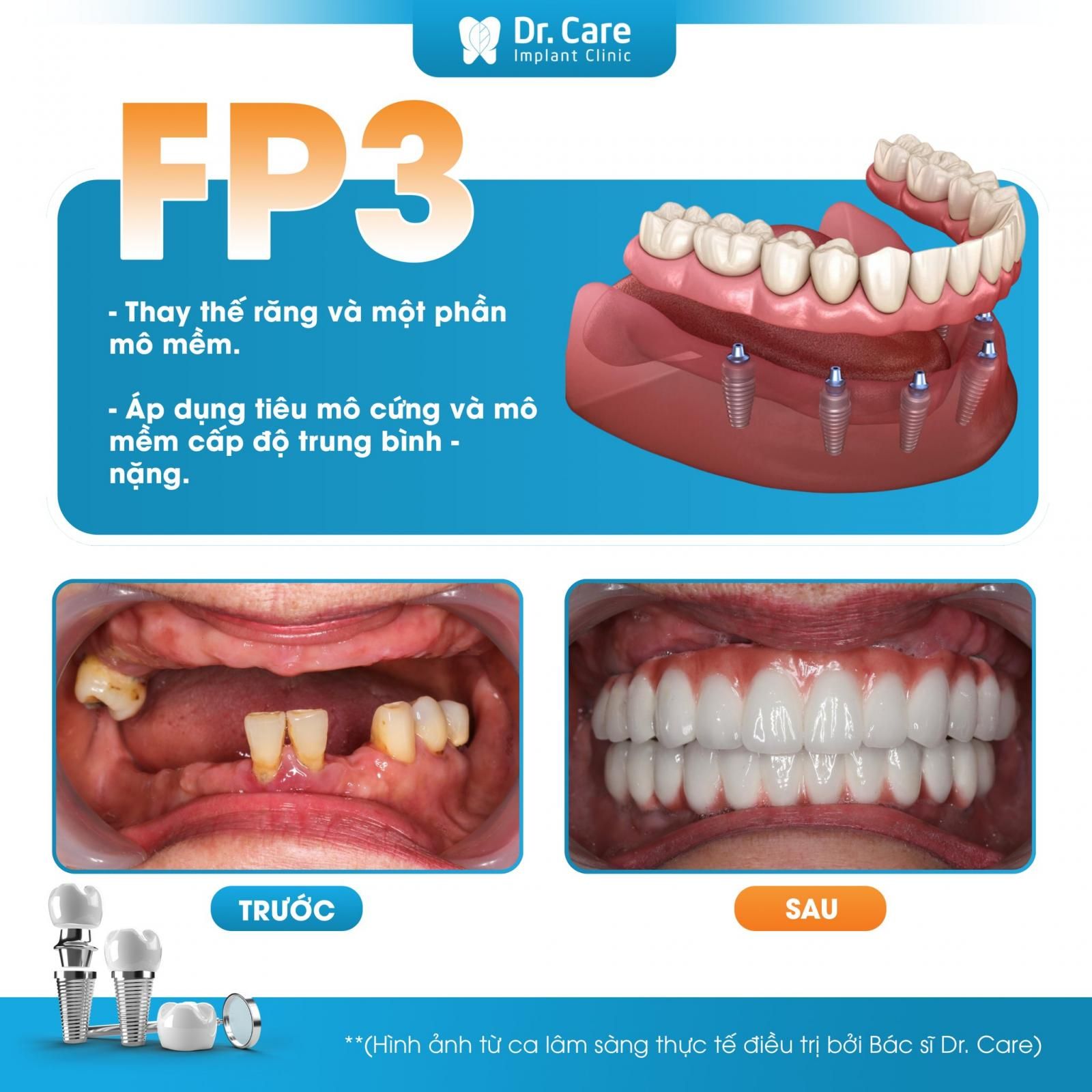 Phục hình FP3