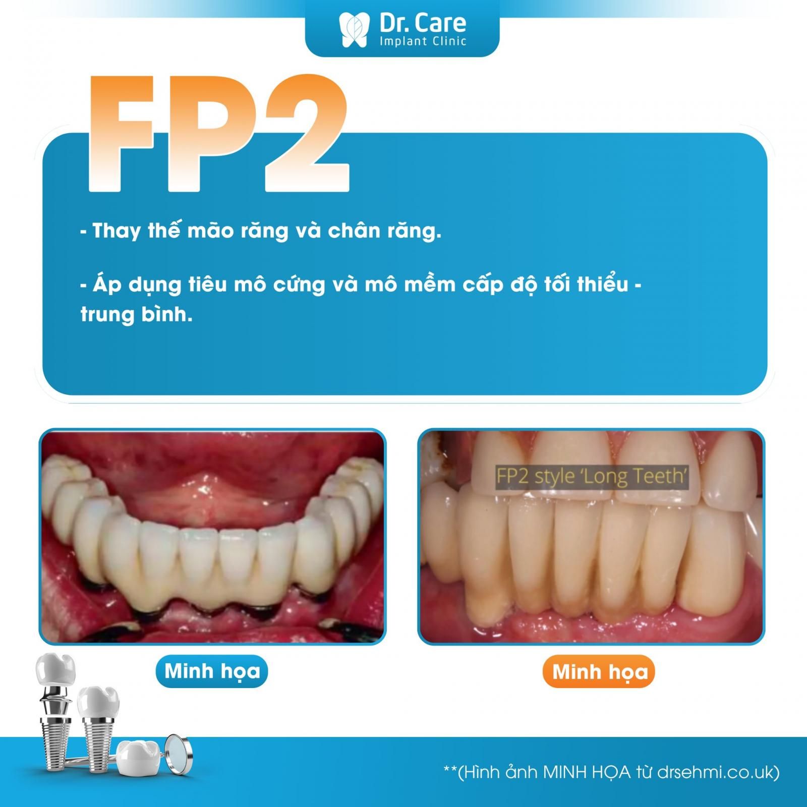 Phục hình FP2