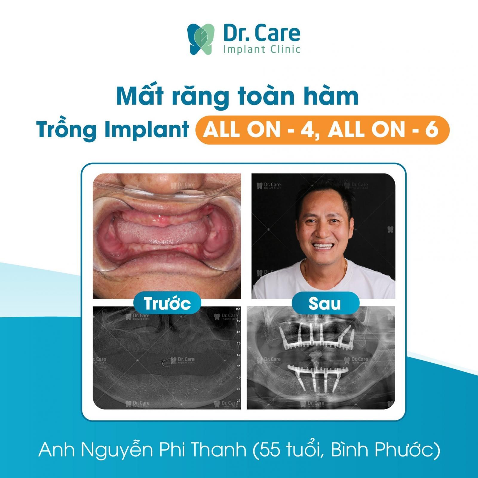 Trồng răng Implant phục hồi mất răng do thiếu hụt canxi