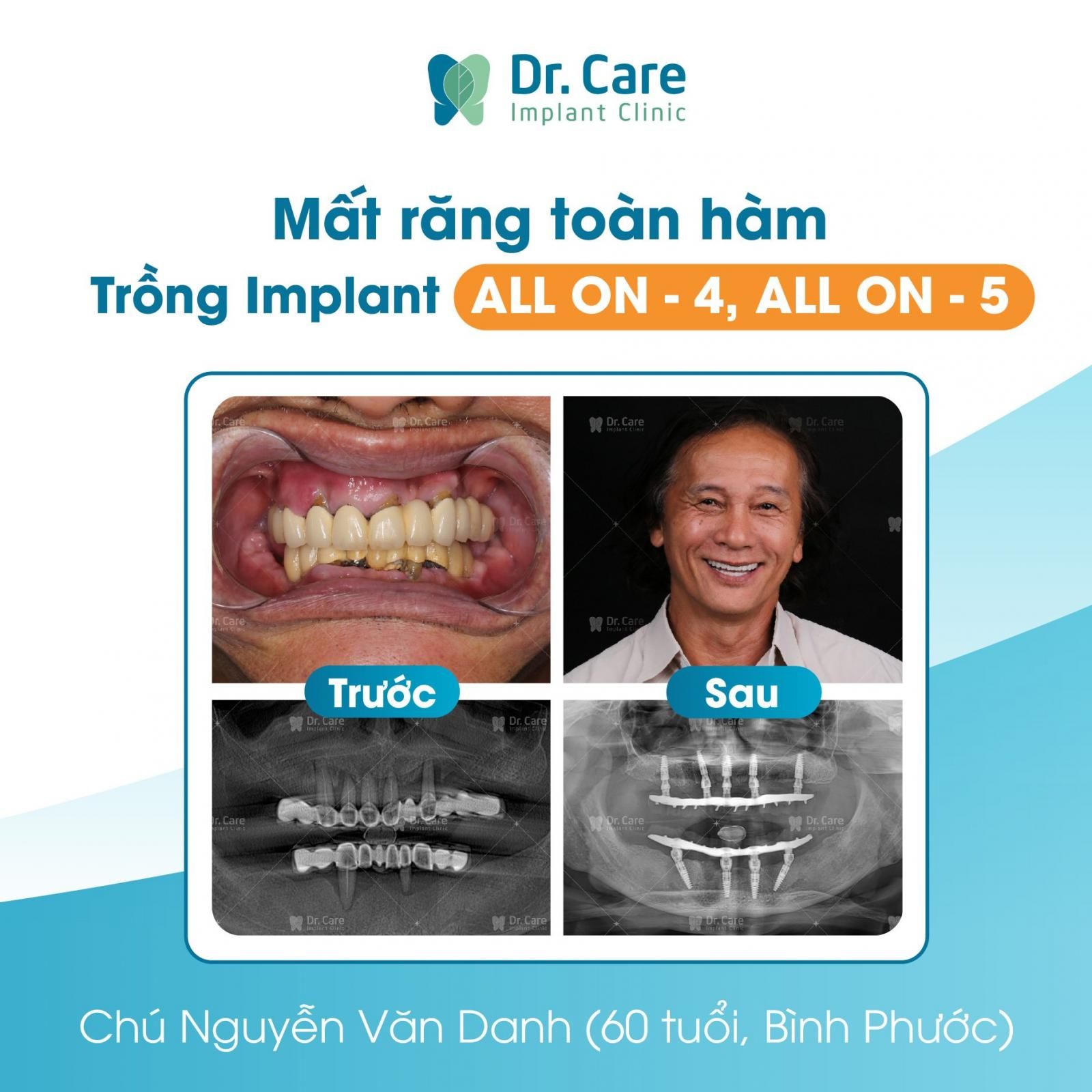 Không xâm lấn, bảo tồn các răng thật kế cận