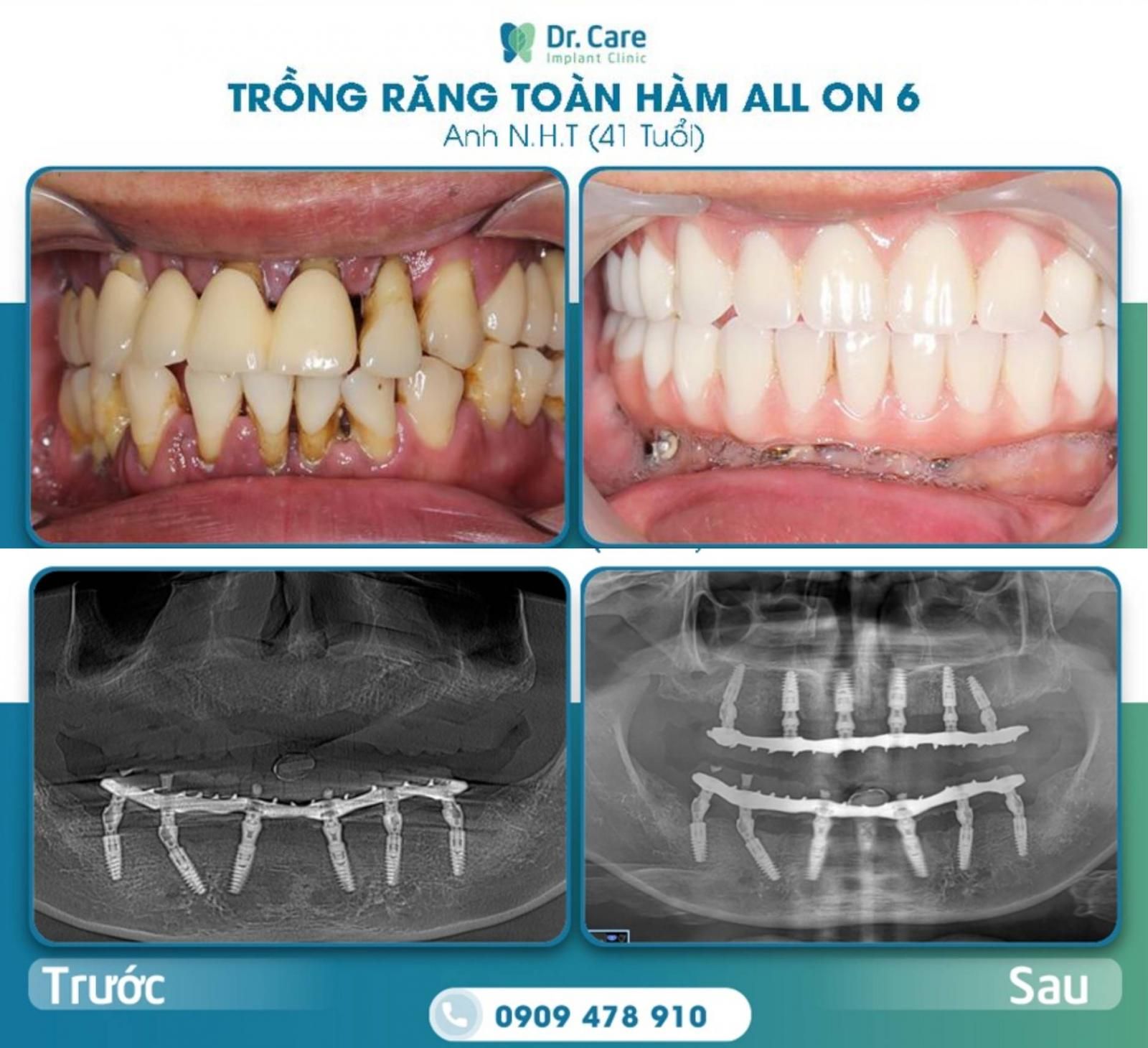 Trồng răng giả nguyên hàm cần bao nhiêu Implant?