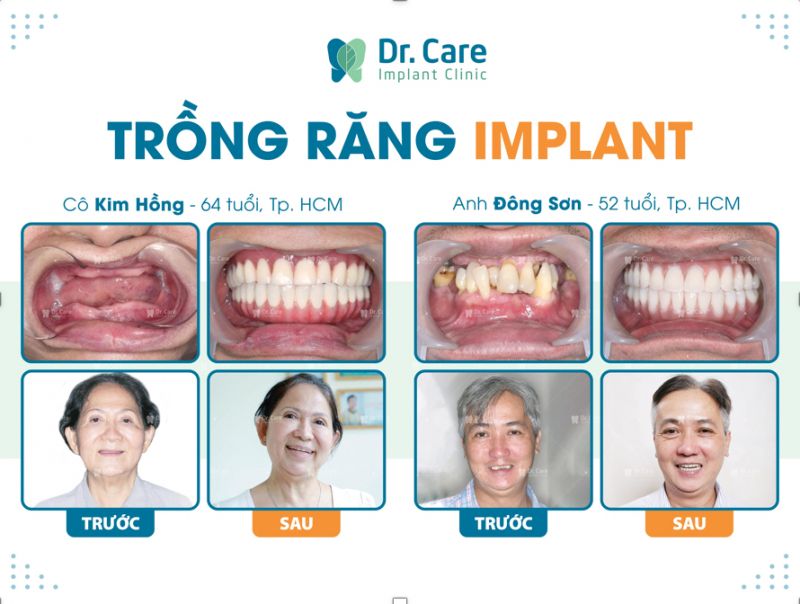 Các dịch vụ trồng răng Implant không đau tại Dr. Care