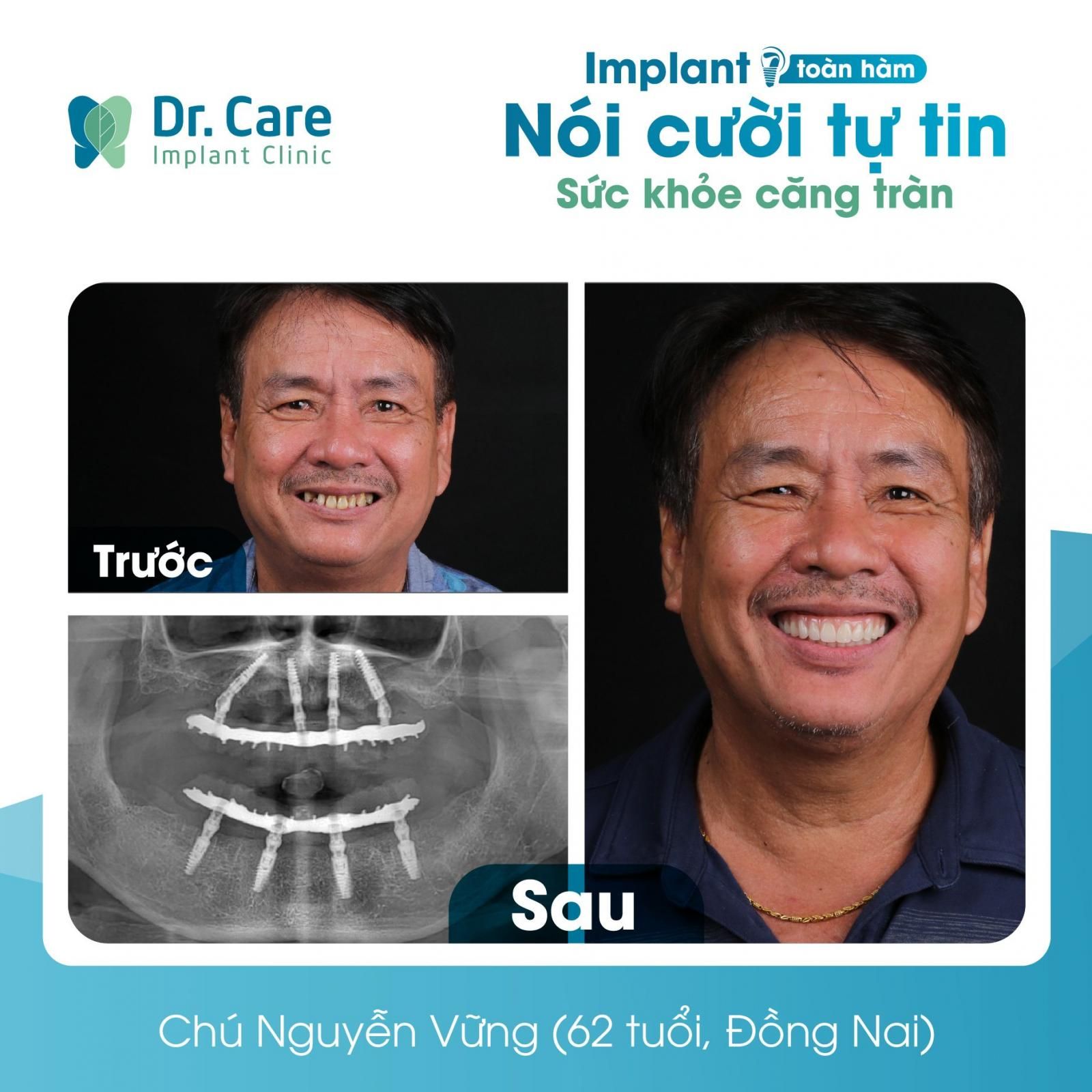 Phương pháp điều trị tại nha khoa