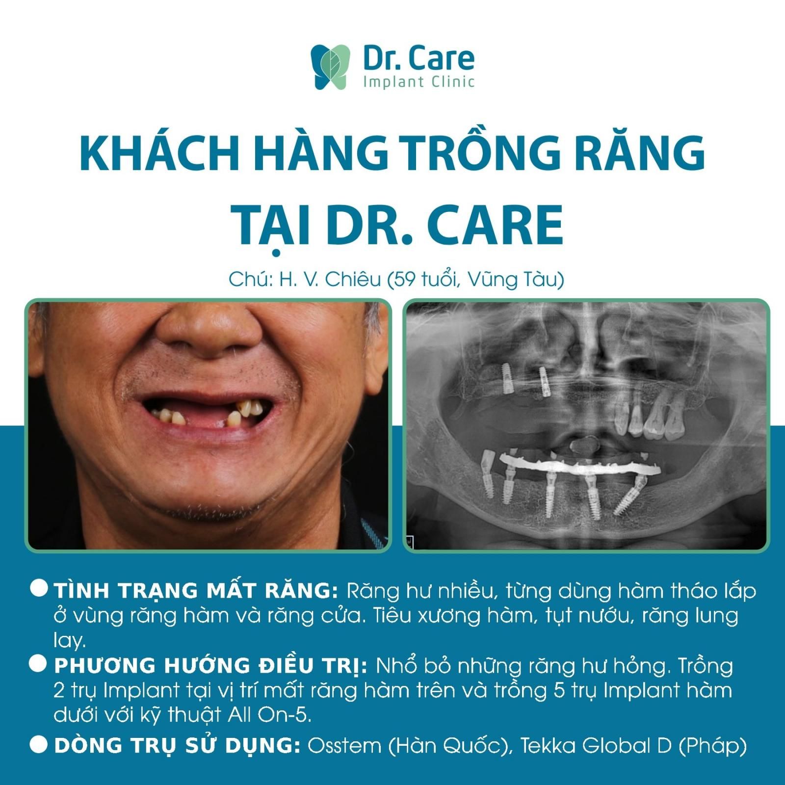 Phục hồi răng hàm dưới bằng Implant All On-4