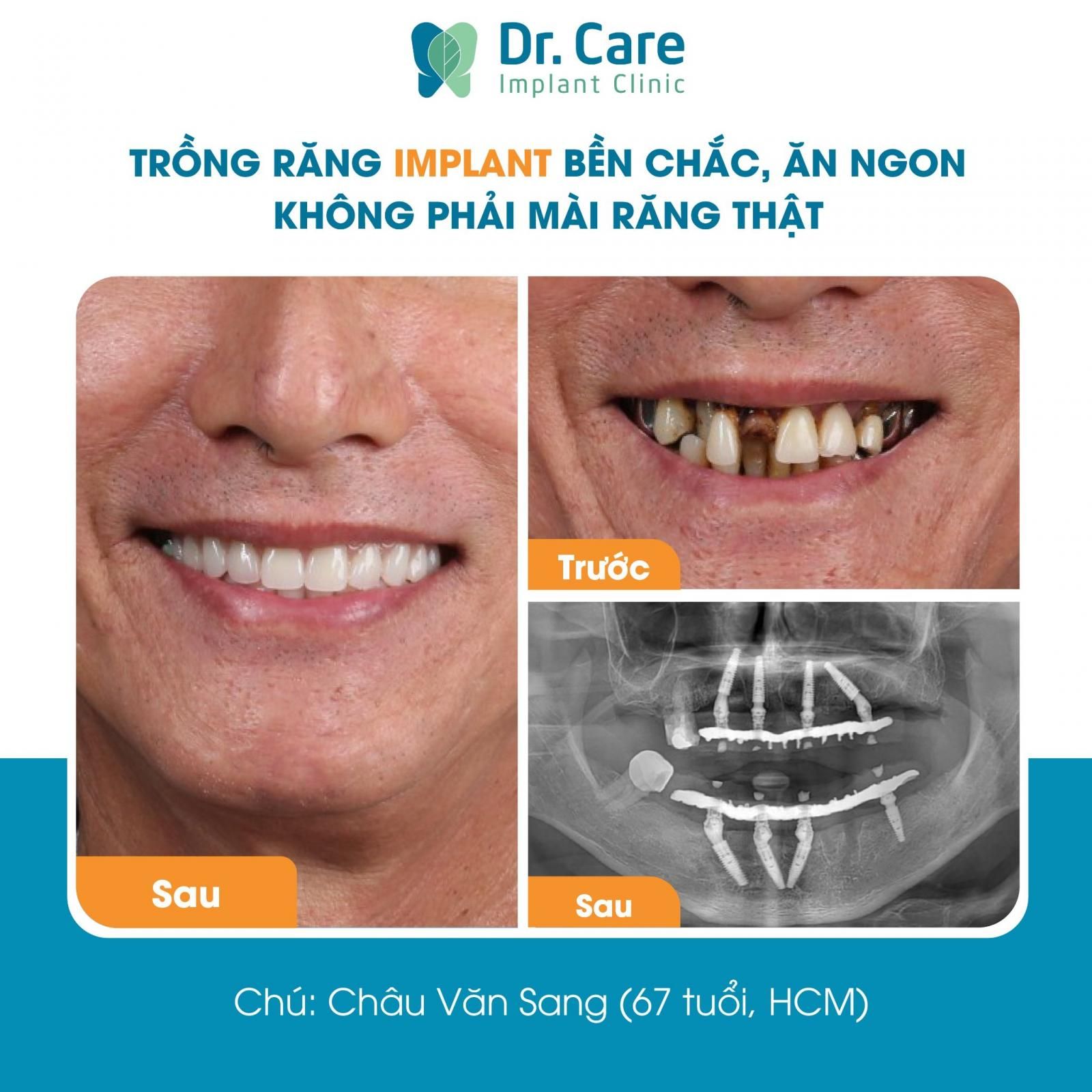 Cấy ghép Implant toàn hàm khắc phục tình trạng mất răng sau khi làm cầu răng sứ 