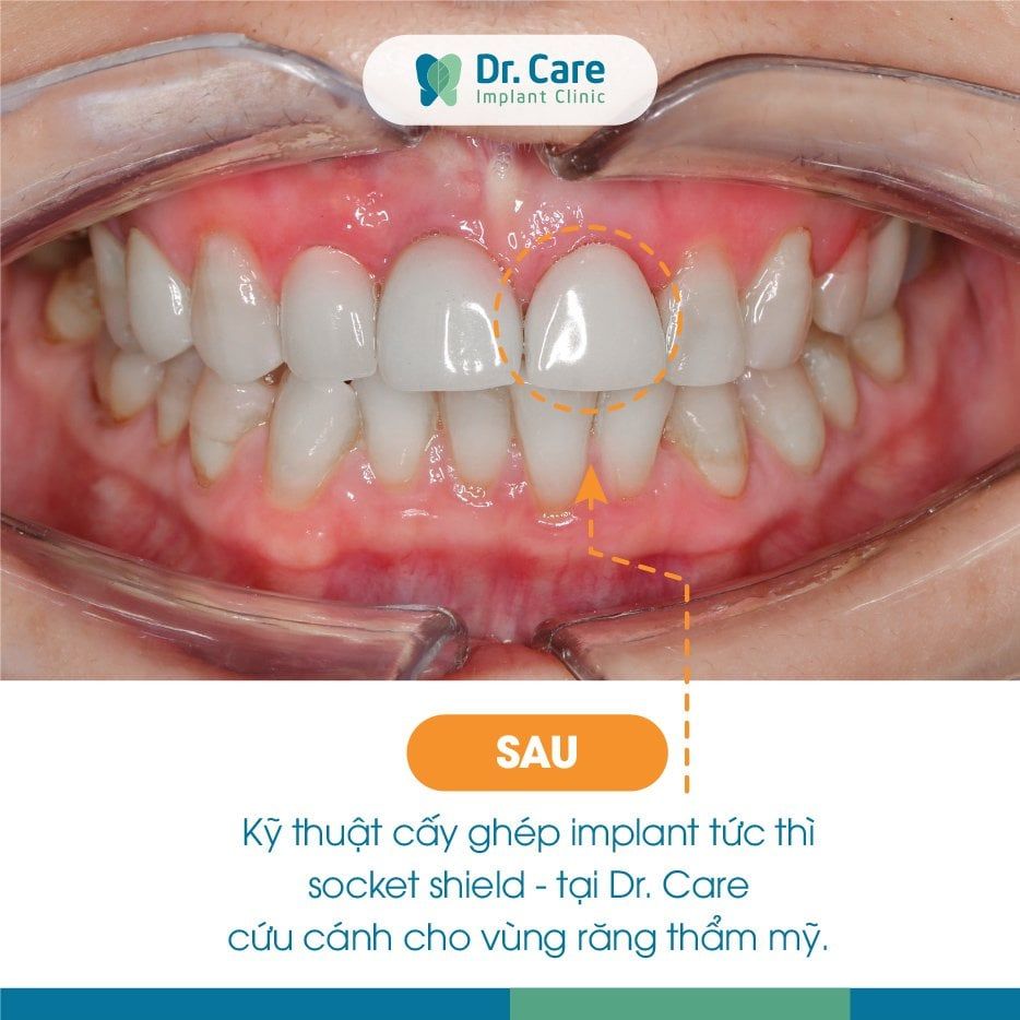 Trồng răng sứ vĩnh viễn trên Implant phục hình tức thì