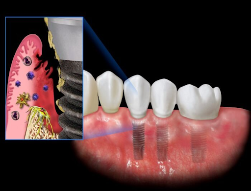 Đau răng sau khi trồng Implant có nguy hiểm không?