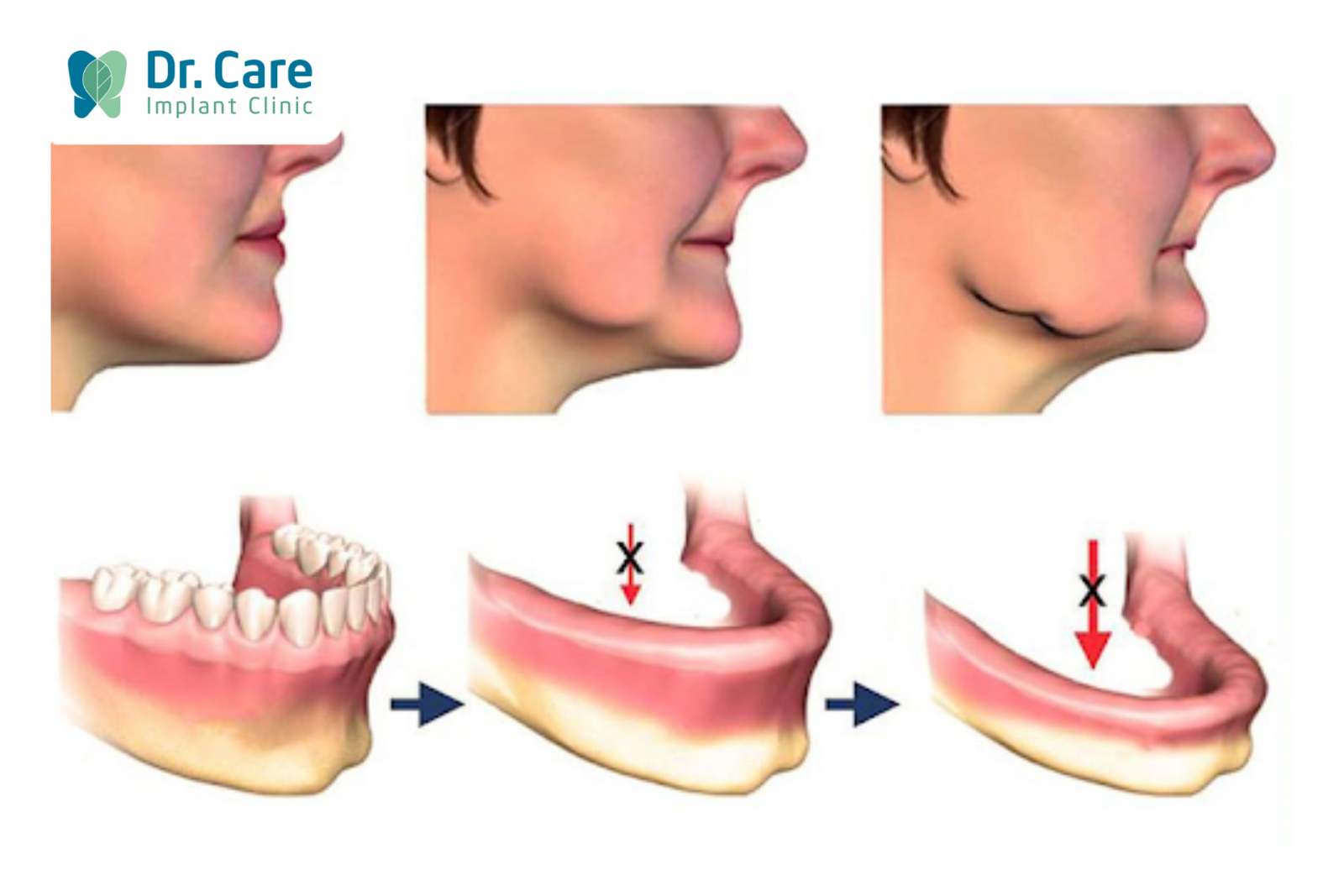 Hậu quả nghiêm trọng của tình trạng tiêu xương hàm