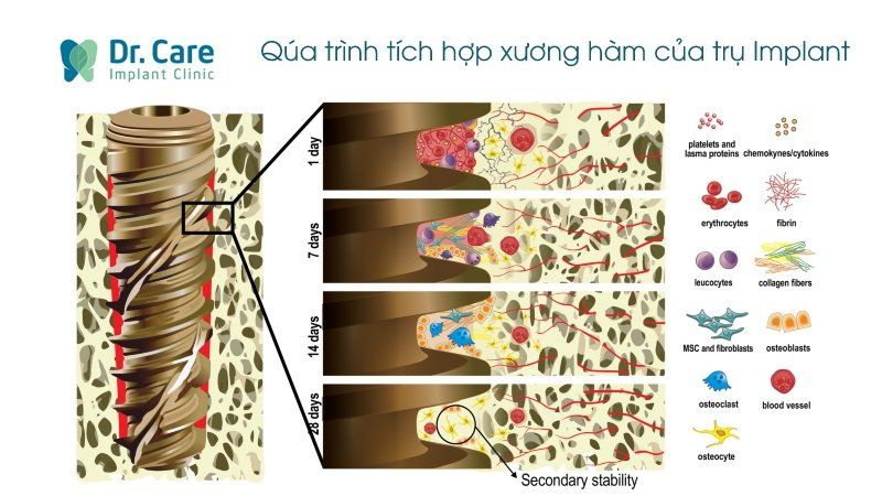 Quá trình tích hợp xương của trụ Implant