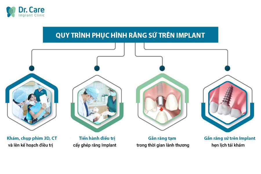 Quy trình phục hình răng sứ trên Implant