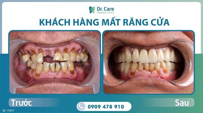 cầu răng sứ và răng implant