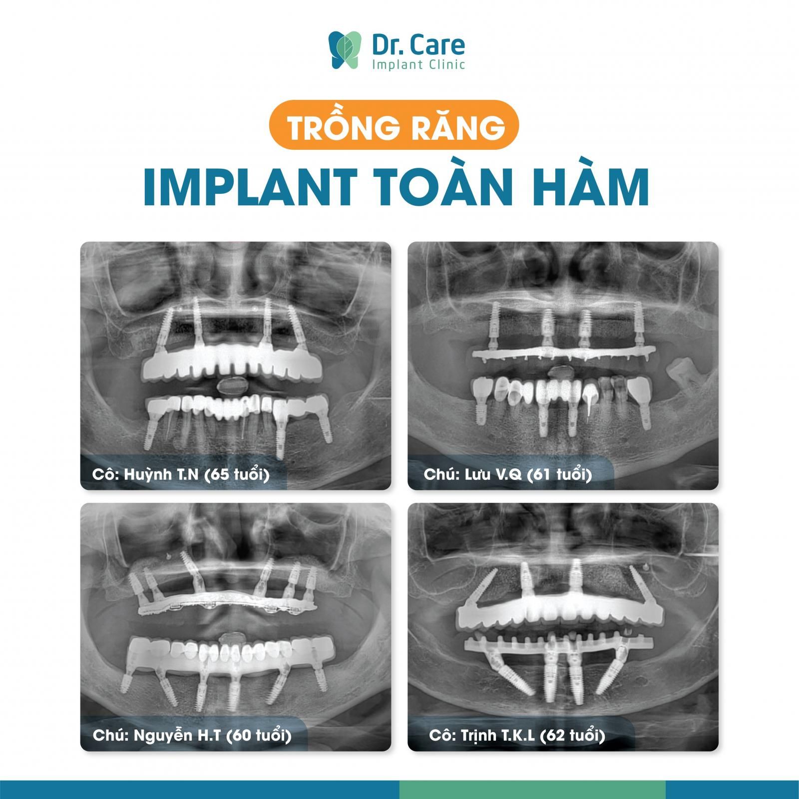 Trồng răng Implant toàn hàm