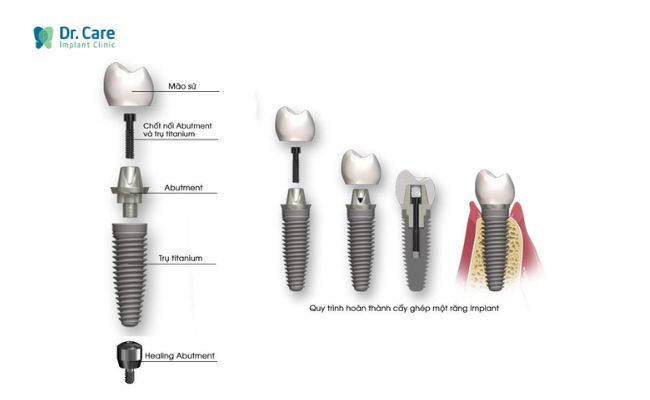 Healing Abutments là gì?