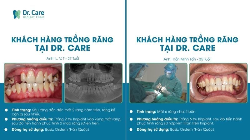 Điều trị thành công hàng nghìn trường hợp mất răng