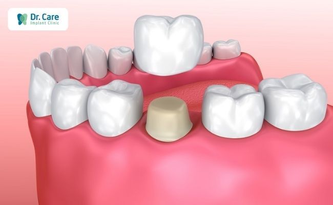 Bọc răng sứ là gì? Những ai nên bọc răng sứ?