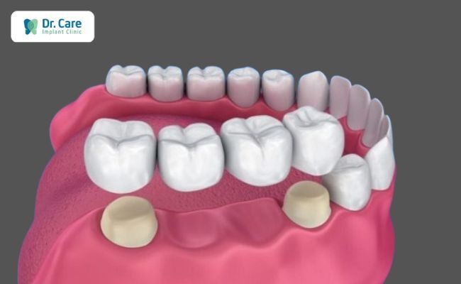 Lắp cầu răng bị lệch