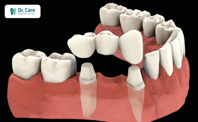 Bọc răng sứ là gì? Bọc răng sứ có tháo ra được không?