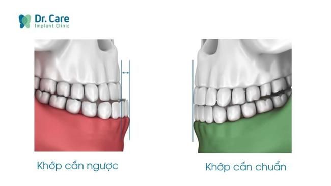 Hai hàm răng cắn khít vào nhau