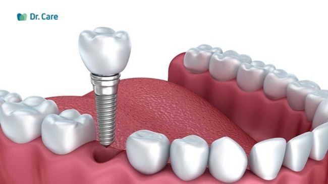 Khớp cắn đóng vai trò quan trọng thế nào trong cấy ghép Implant