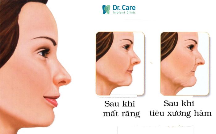 Mất răng bao lâu thì bị tiêu xương hàm?