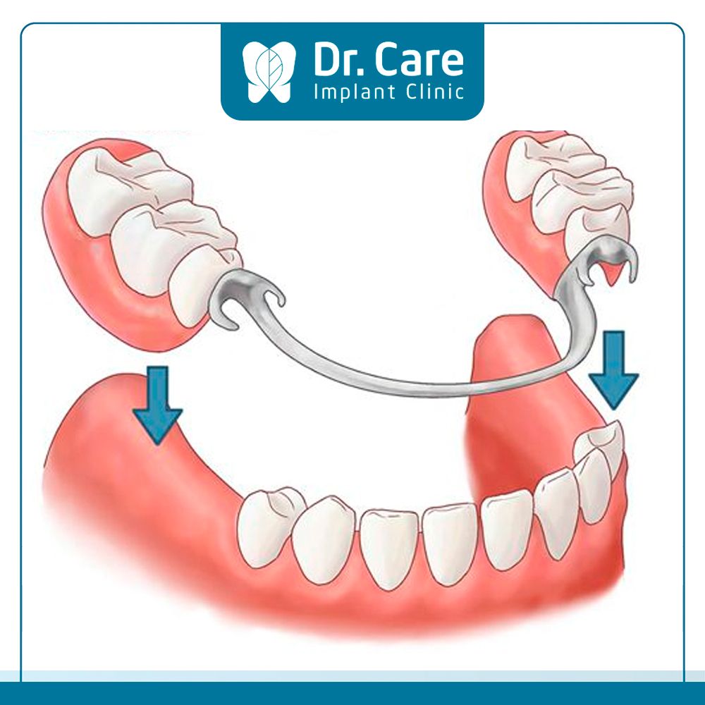 Răng tháo lắp có chi phí rẻ nhất trong các phương pháp trồng răng nhưng lỏng lẻo nên dễ rơi rớt