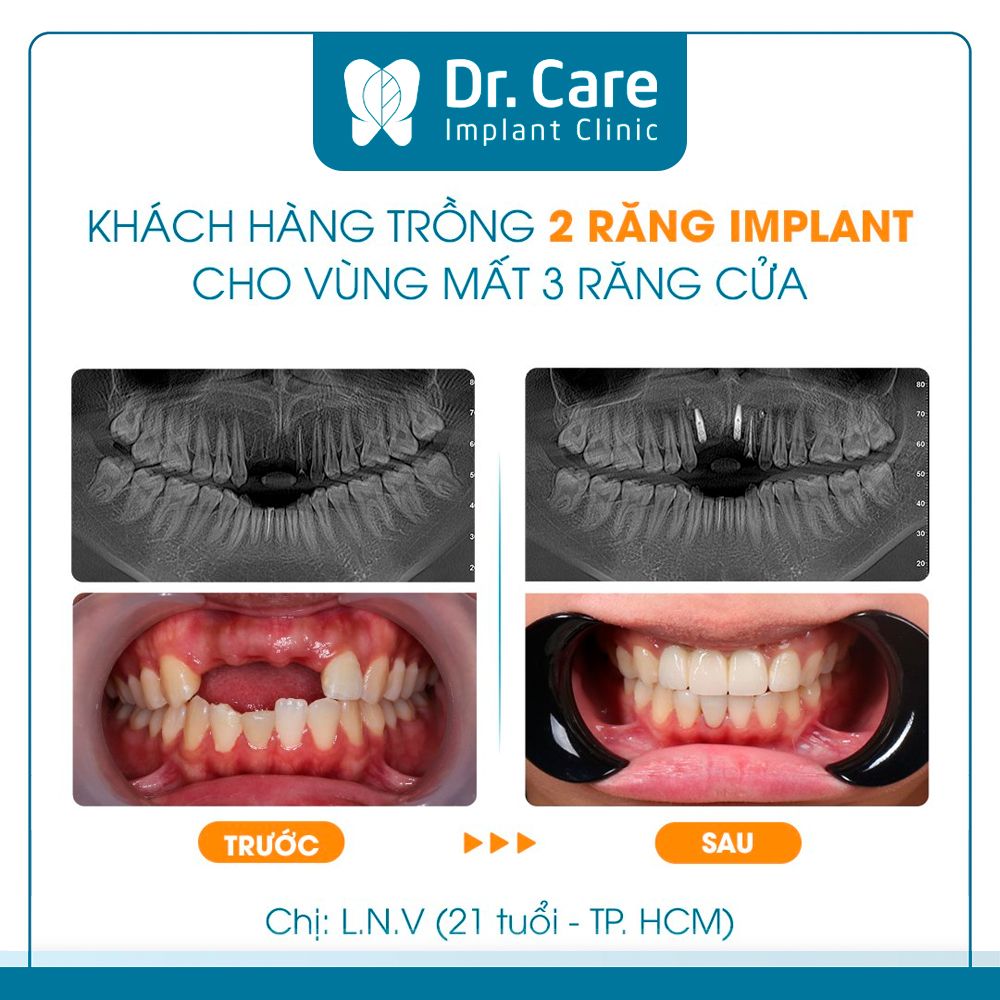 Khi mất 3 răng liên tiếp thì nên ưu tiên lựa chọn trồng răng Implant