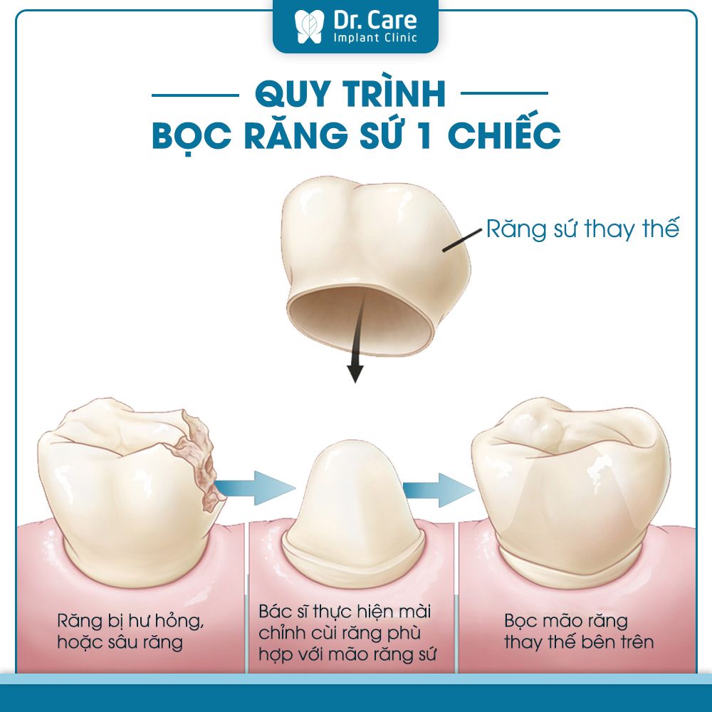 Quy trình bọc răng sứ 1 chiếc hiệu quả, an toàn