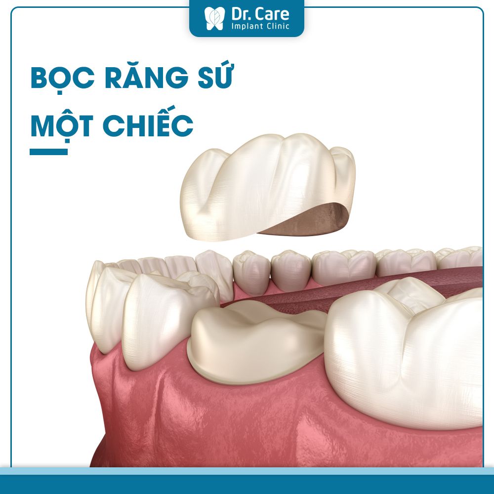 4. Chi phí bọc răng sứ 1 chiếc