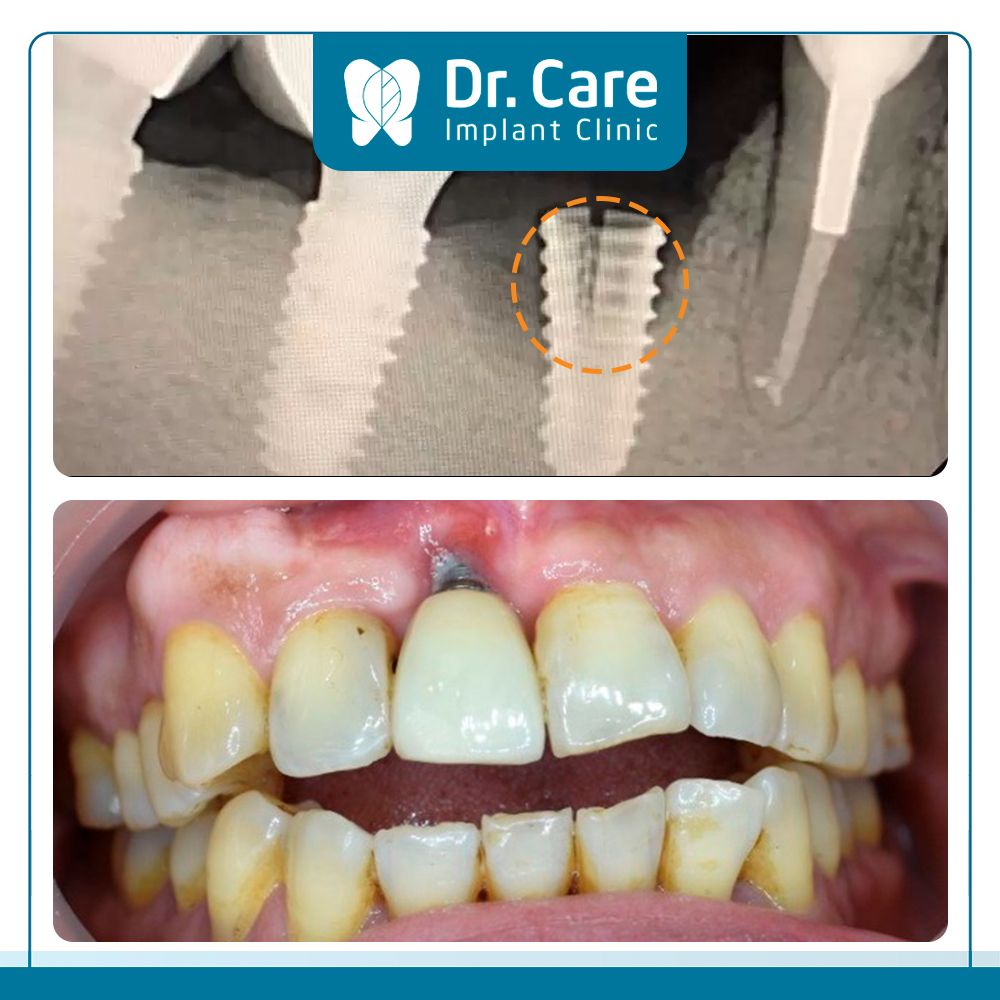 Dấu hiệu cho thấy Implant bị đào thải