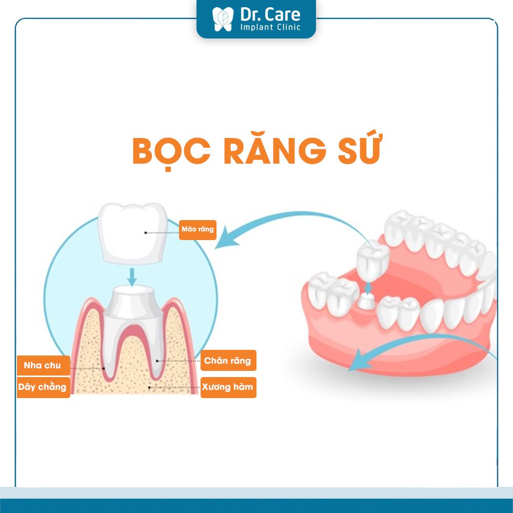  Bọc răng sứ mất bao lâu để hoàn thành?