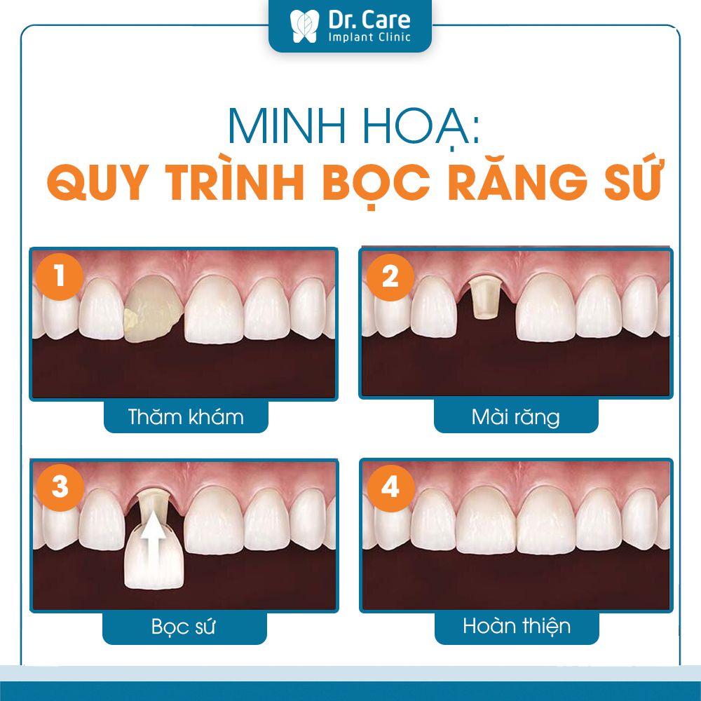 Sau bọc sứ, bao lâu thì hồi phục hoàn toàn?