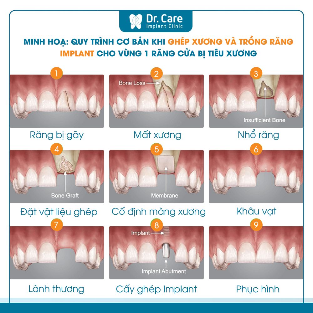 Quy trình ghép xương chuẩn Y khoa tại nha khoa Dr. Care