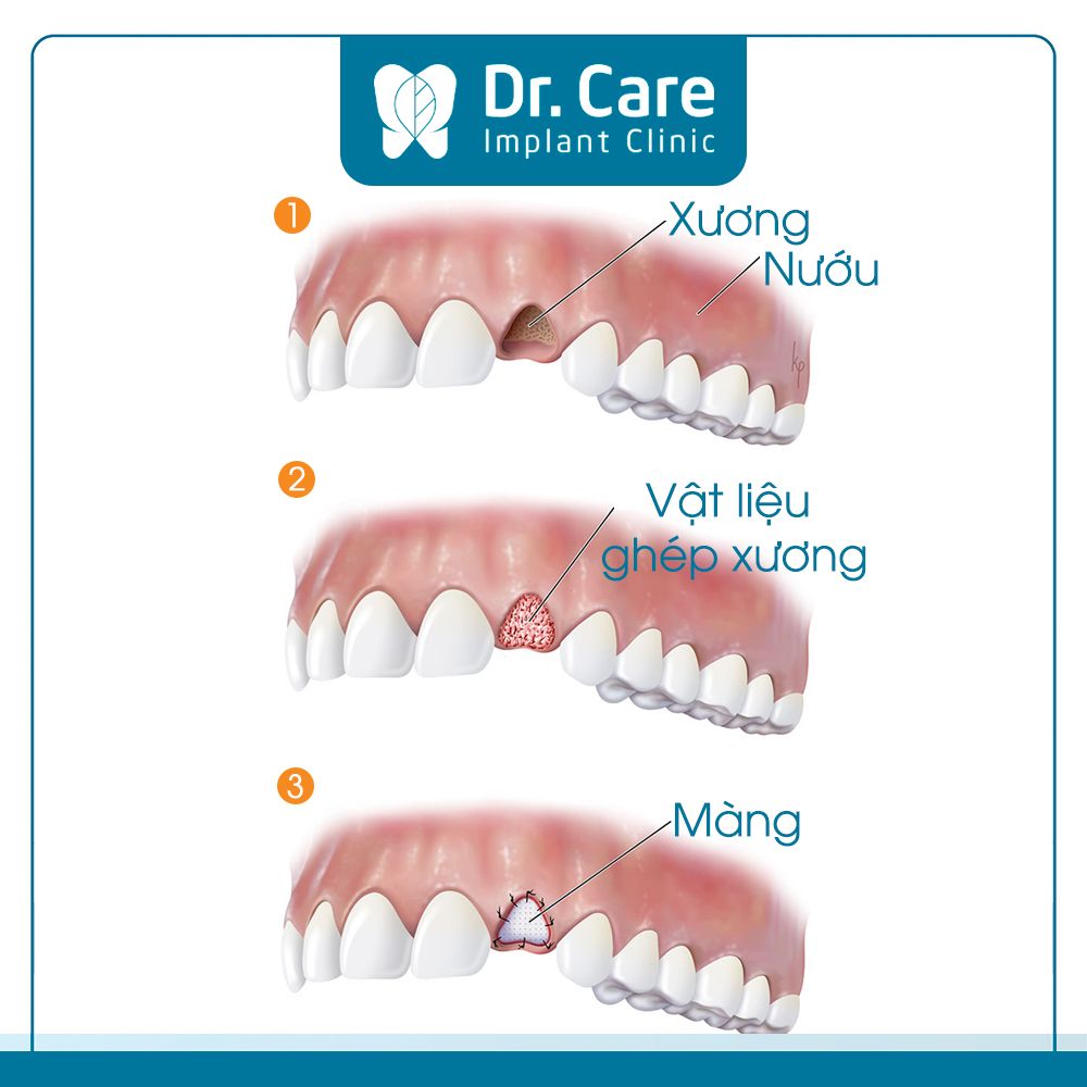 Ghép xương hàm trong cấy Implant là gì?