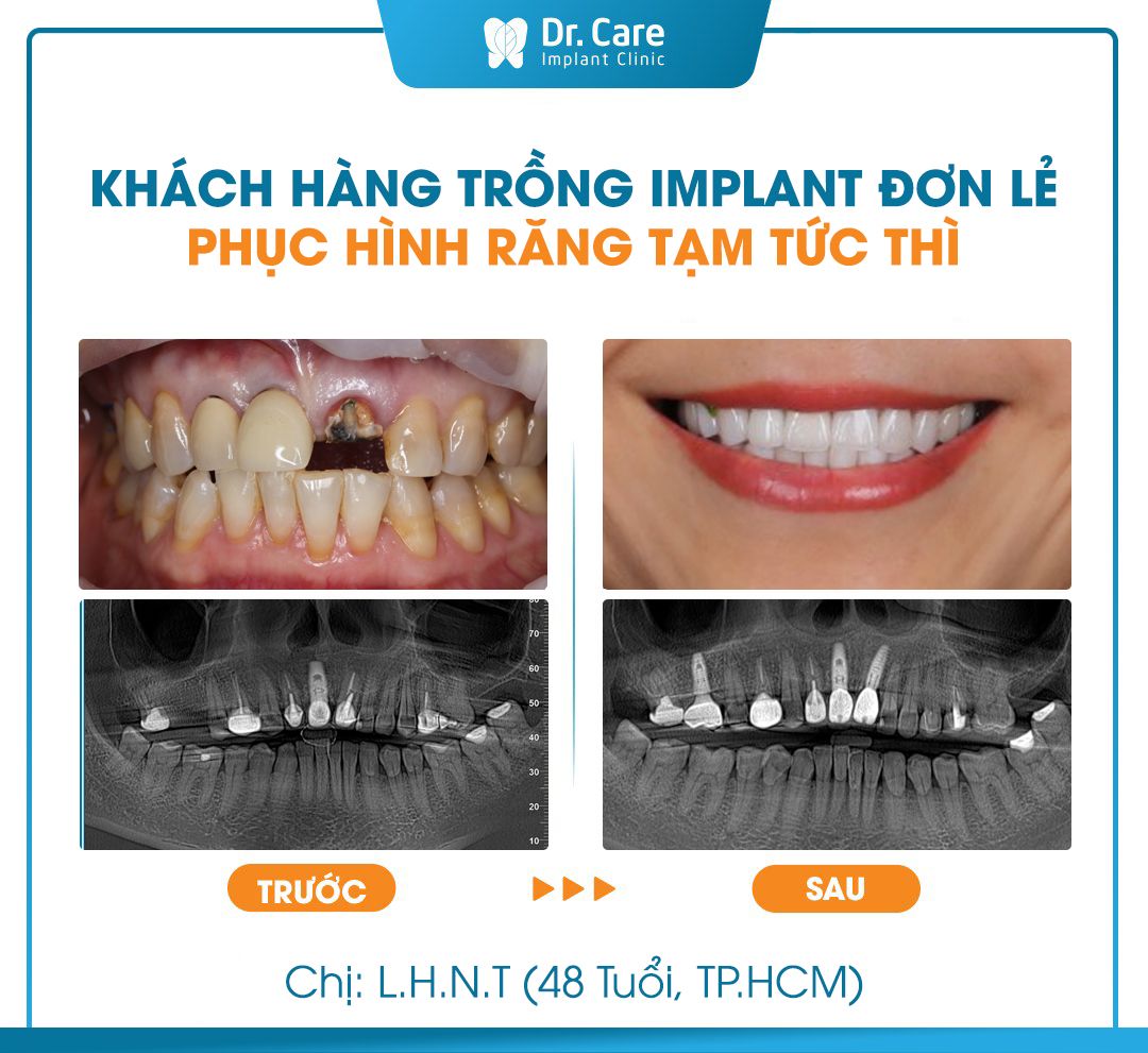 Những điều cần lưu ý khi lấy dấu trong phục hình đơn lẻ và lấy dấu khi phục hình tức thì trên Implant 