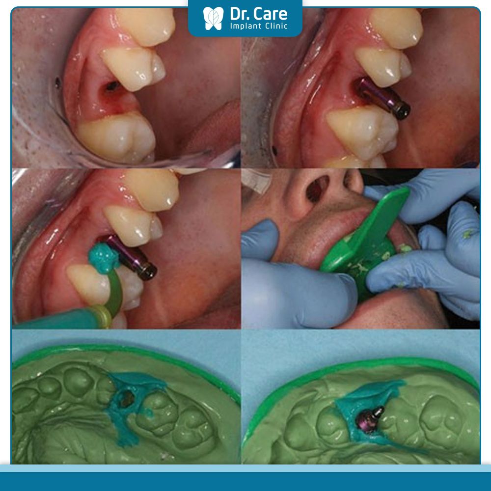 Quy trình lấy dấu răng trên Implant