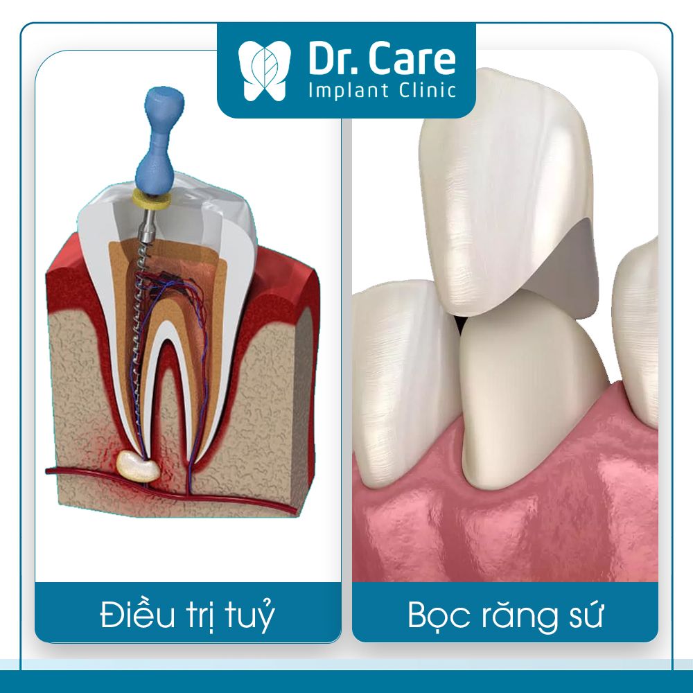 Lấy tủy, bọc răng sứ giá bao nhiêu