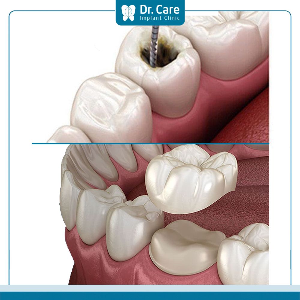 Vì sao sau khi lấy tủy răng cần bọc sứ? 