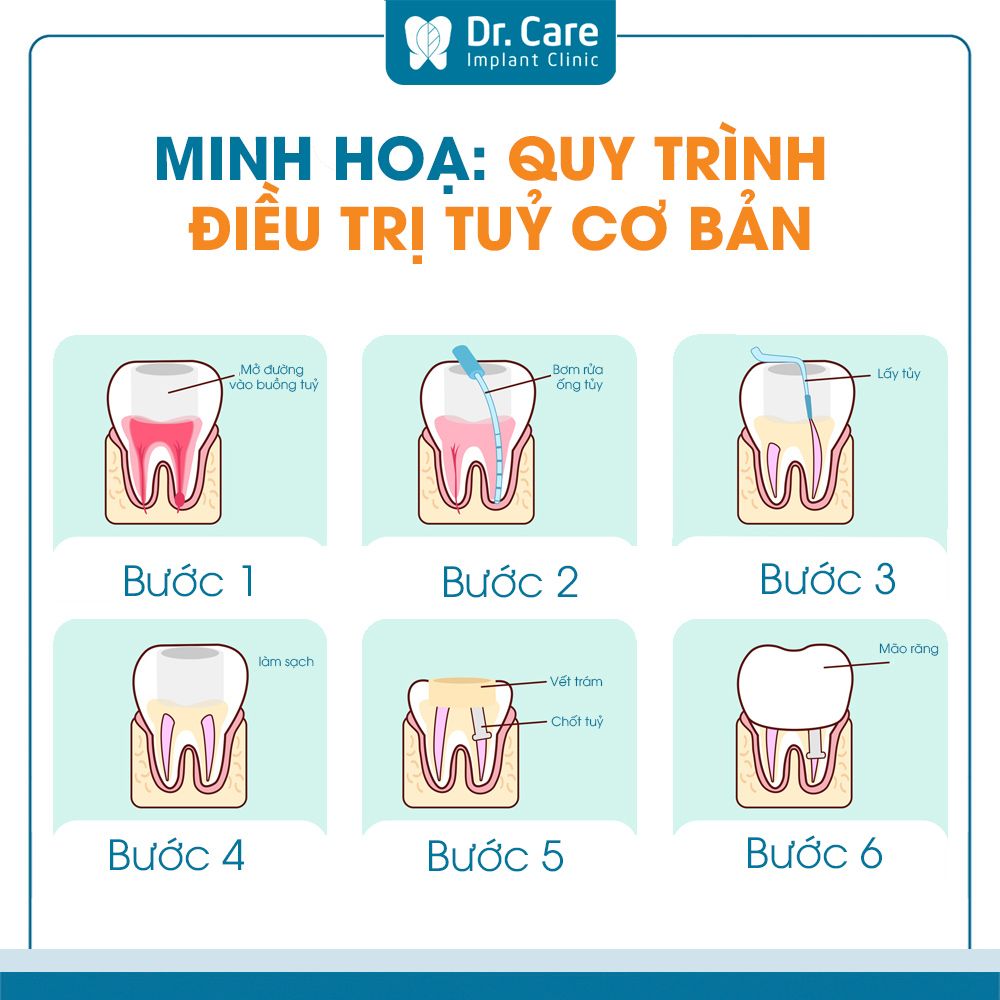 Lấy tủy bọc răng sứ có đau không? 