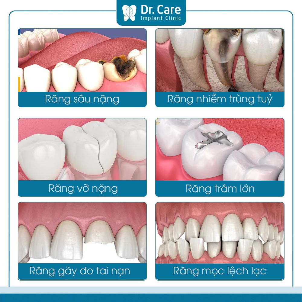 Các trường hợp cần lấy tủy bọc răng sứ