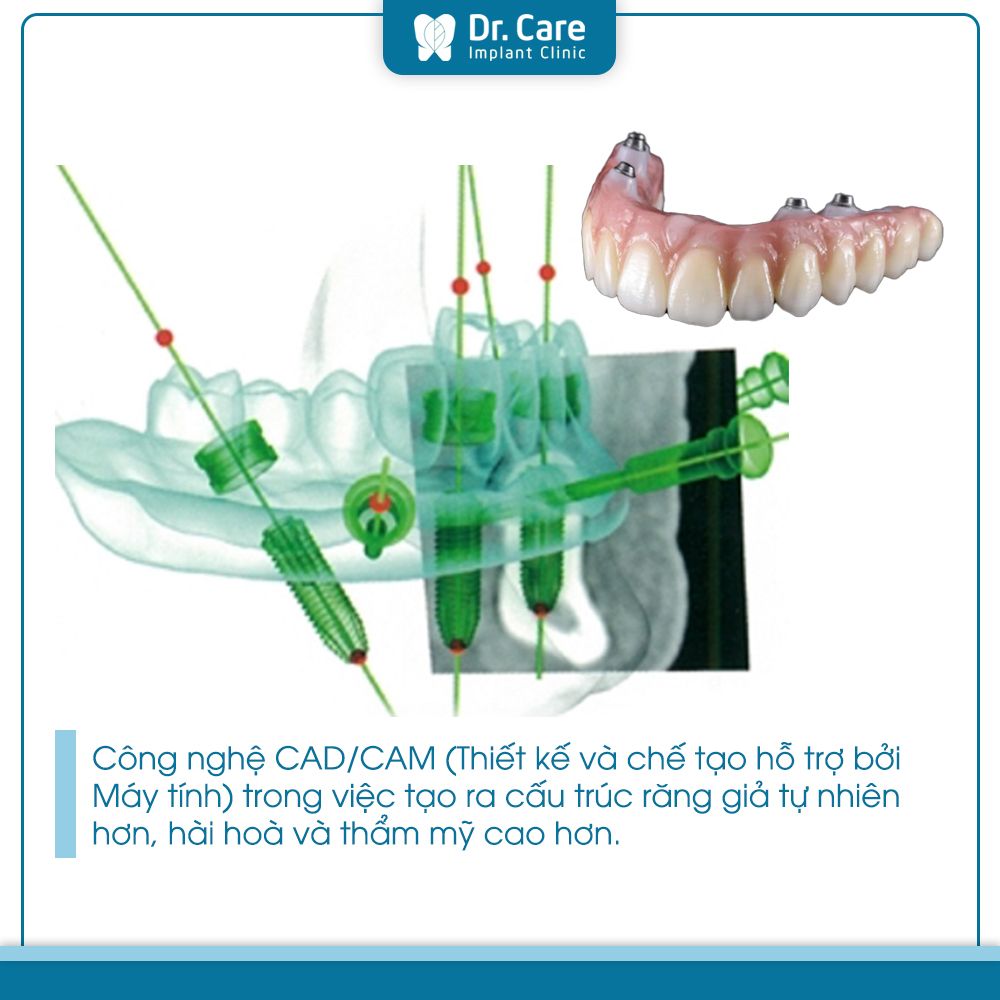 Các giai đoạn cải cách về thiết kế, chức năng của răng Implant 