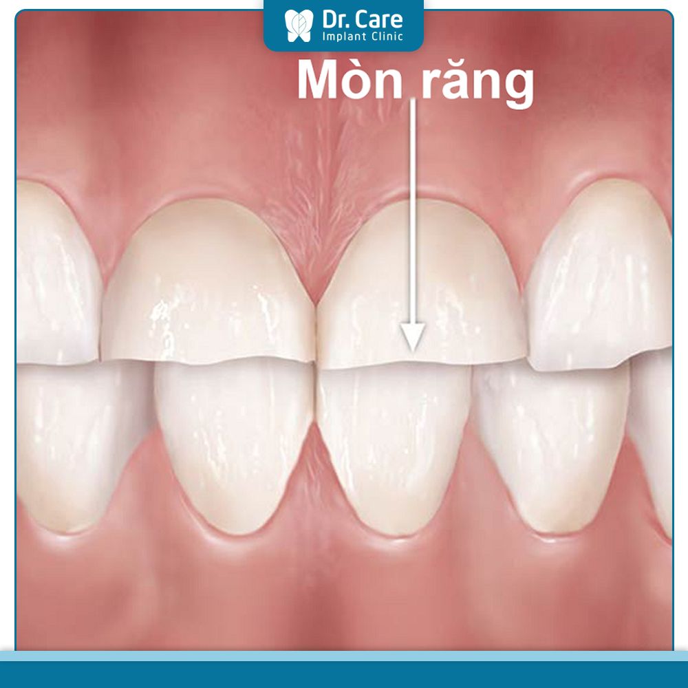 Hậu quả của việc răng sứ bị mòn 