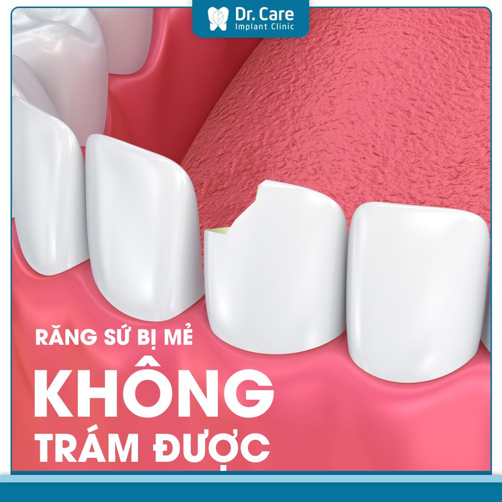 Răng sứ bị mẻ có trám được không?