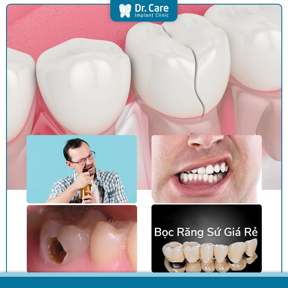 Nguyên nhân khiến răng sứ bị mẻ, vỡ?