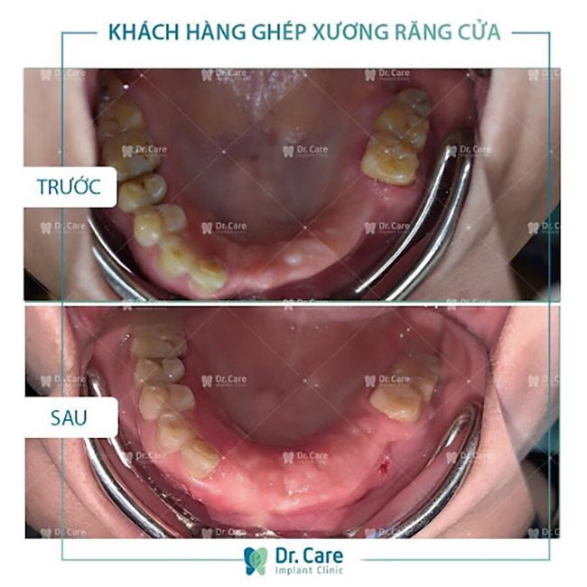 Trồng răng giả cho người già