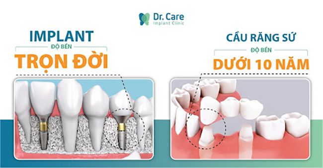 Trồng răng giả cho người già